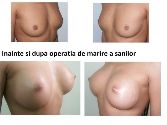 Poza marirea sanilor implante silicon inainte si dupa operatie