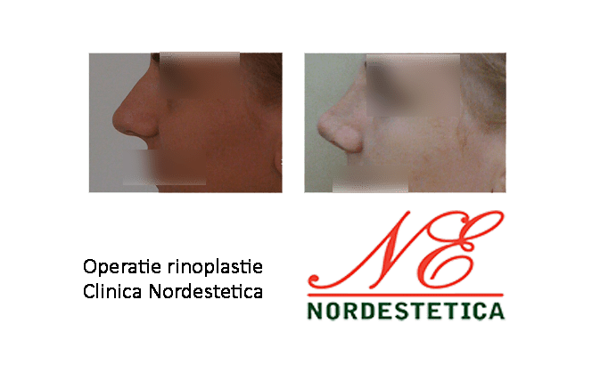 Operatie estetica rinocorectie Clinica Nordestetica