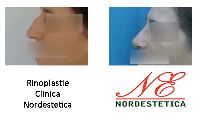 Rinoplastie Clinica Nordestetica